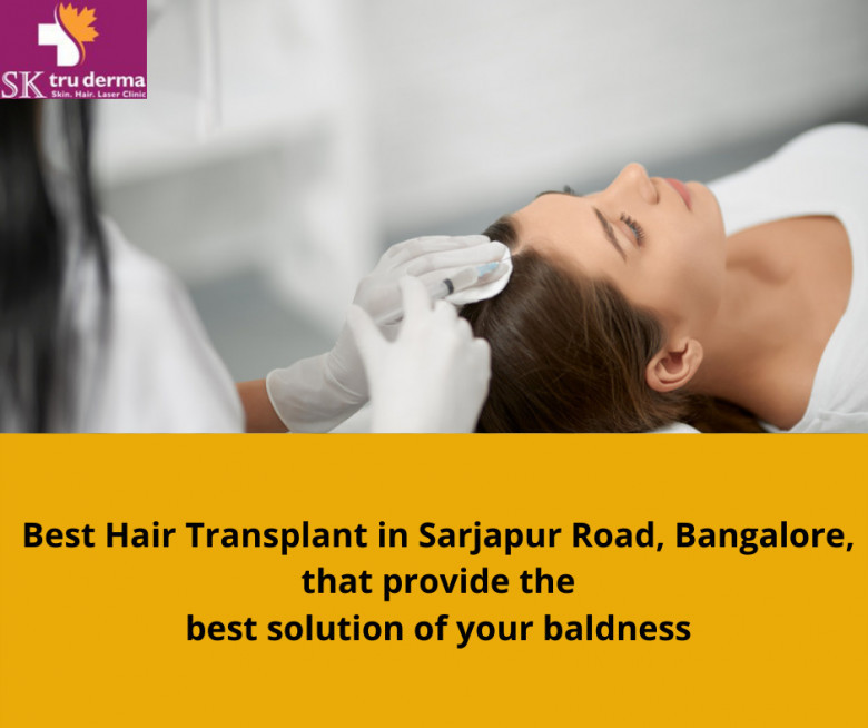 Hair Transplantation in Bangalore | Sktruderma | Best Hair Transplant